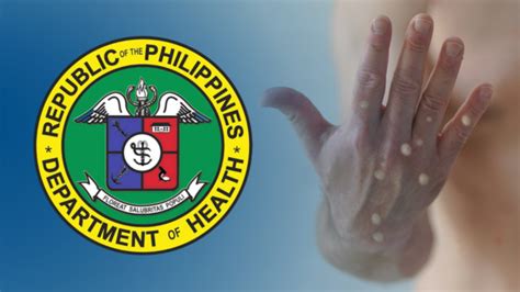 Two more cases of mpox were reported in the country, DOH said..